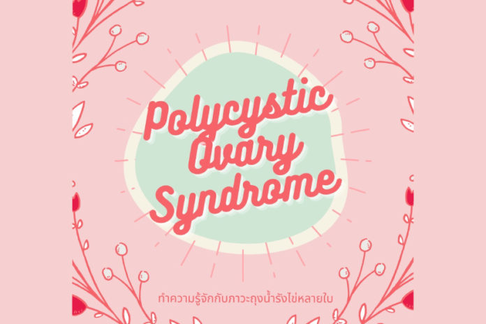 ทำความรู้จักกับภาวะถุงน้ำรังไข่หลายใบ (Polycystic Ovarian Syndrome, PCOS)